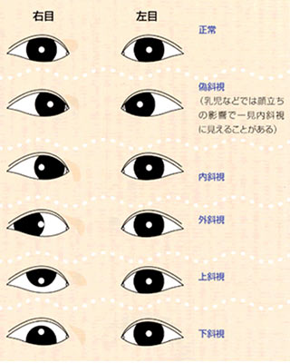 斜視の種類について