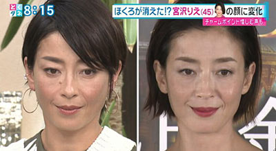 宮沢りえのほくろありとほくろなし